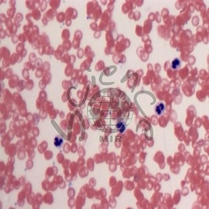 겸형적혈구 슬라이드 표본 겸형적혈구,슬라이드,표본